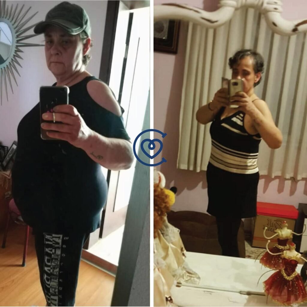 gastric-sleeve-before-after