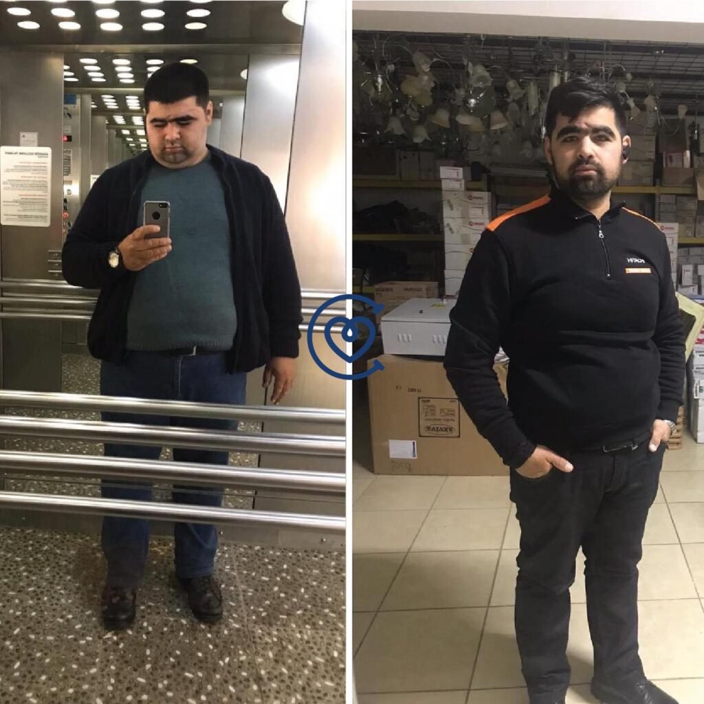 gastric-sleeve-before-after