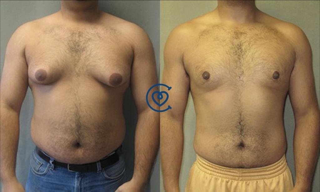 Gynecomastia Surgery 4 gynecomastia-before-and-after