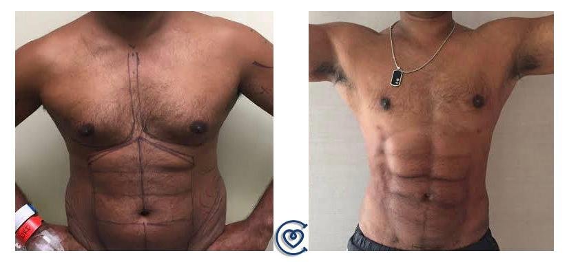 gynecomastia-before-and-after