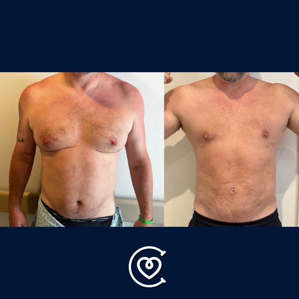 Gynecomastia Surgery 6 gynecomastia-before-and-after