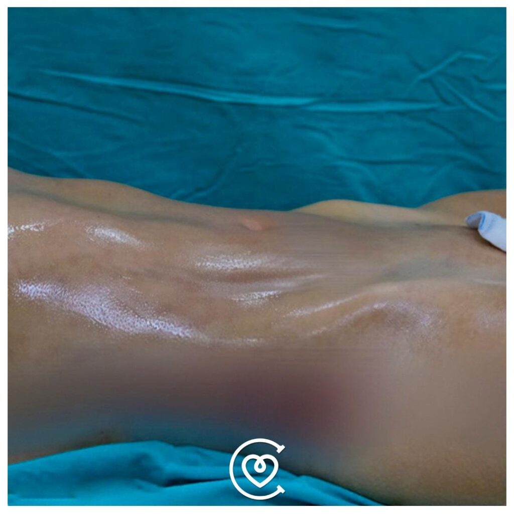 J-Plasma Skin Tightening in Turkey 2026 3 J-plasma-after-procedure