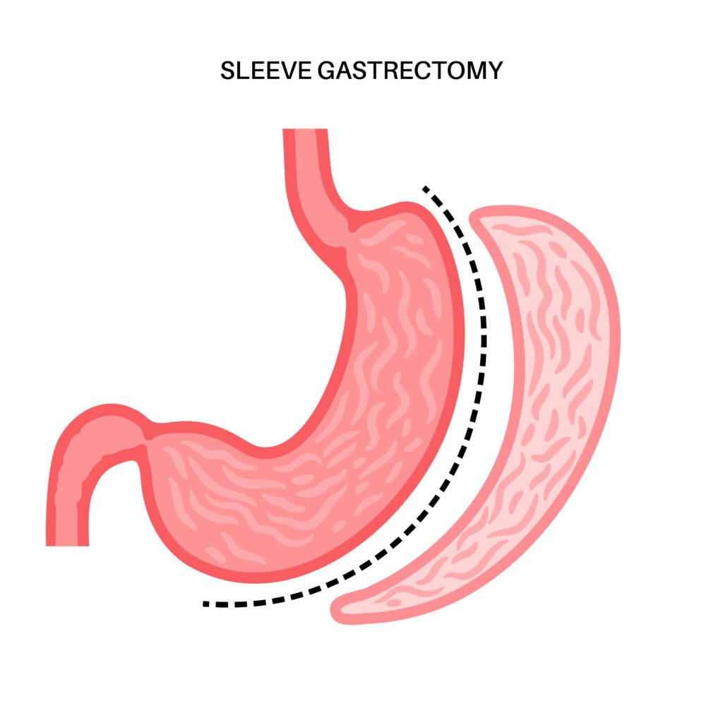 Laparoscopic sleeve gastrectomy