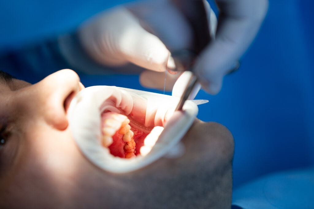 Gum Disease 2 gum-graft-transplant