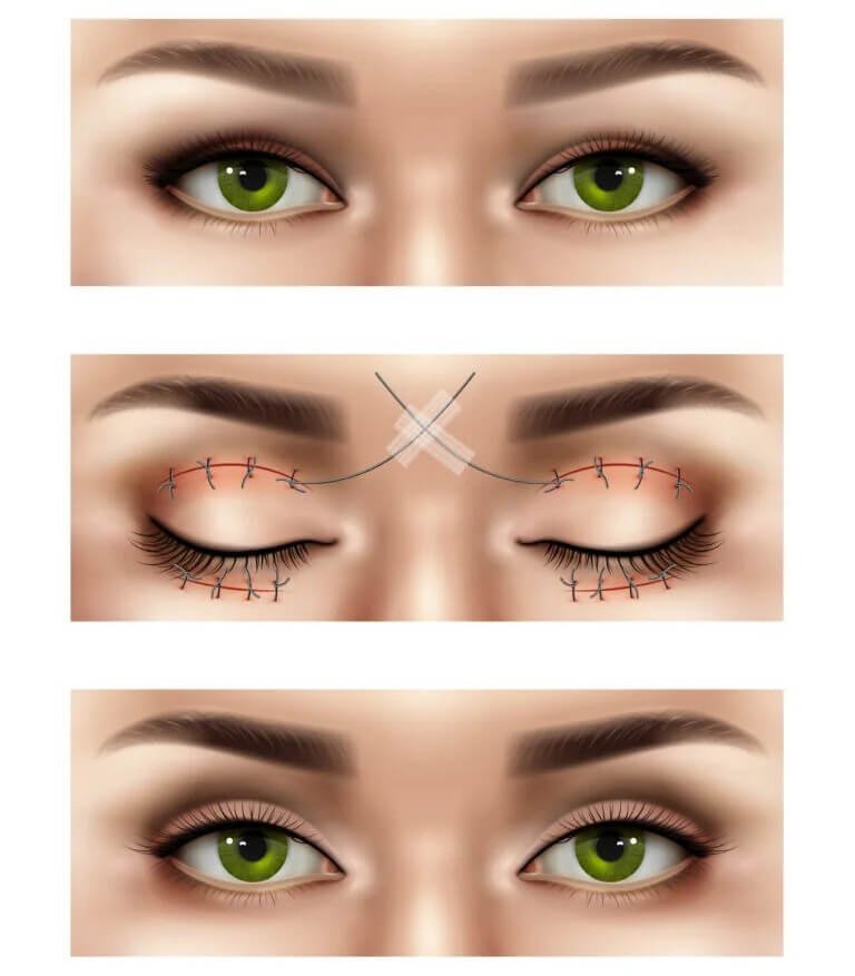 Upper Eyelid Surgery Blepharoplasty
