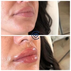 Lip Augmentation-Before & After
