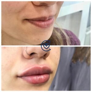 Lip Augmentation Surgery | Cayra Clinic 6 Lip Augmentation-Before & After