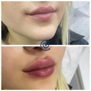 Lip Augmentation Surgery | Cayra Clinic 5 Lip Augmentation-Before & After