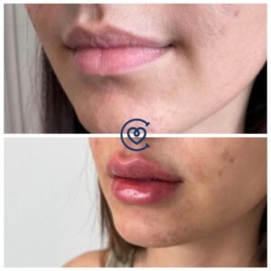 Lip Augmentation-Before & After
