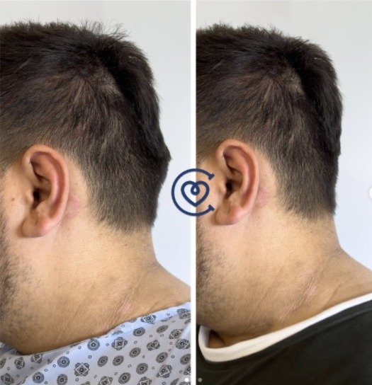 Occipital Bone Reduction Surgery Turkey: 5-7 Days Recovery | Cayra 1 Occipital bone reduction surgery before and after - real patient Tim - Cayra Clinic Turkey
