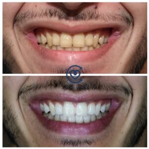 Teeth Whitening before after photo