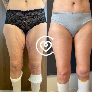 Thіgh Lіft Ѕurgеrу - Before & After