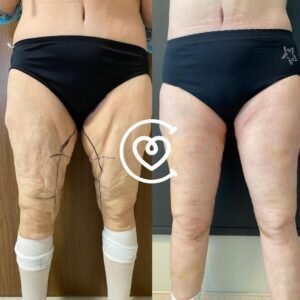 Thіgh Lіft Ѕurgеrу - Before & After