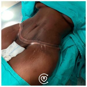 Tummy Tuck Surgery in Turkey: Cost, Recovery & Expert Care 2026 3 Tummy Tuck At Cayra