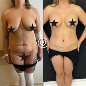 Tummy Tuck Before & After