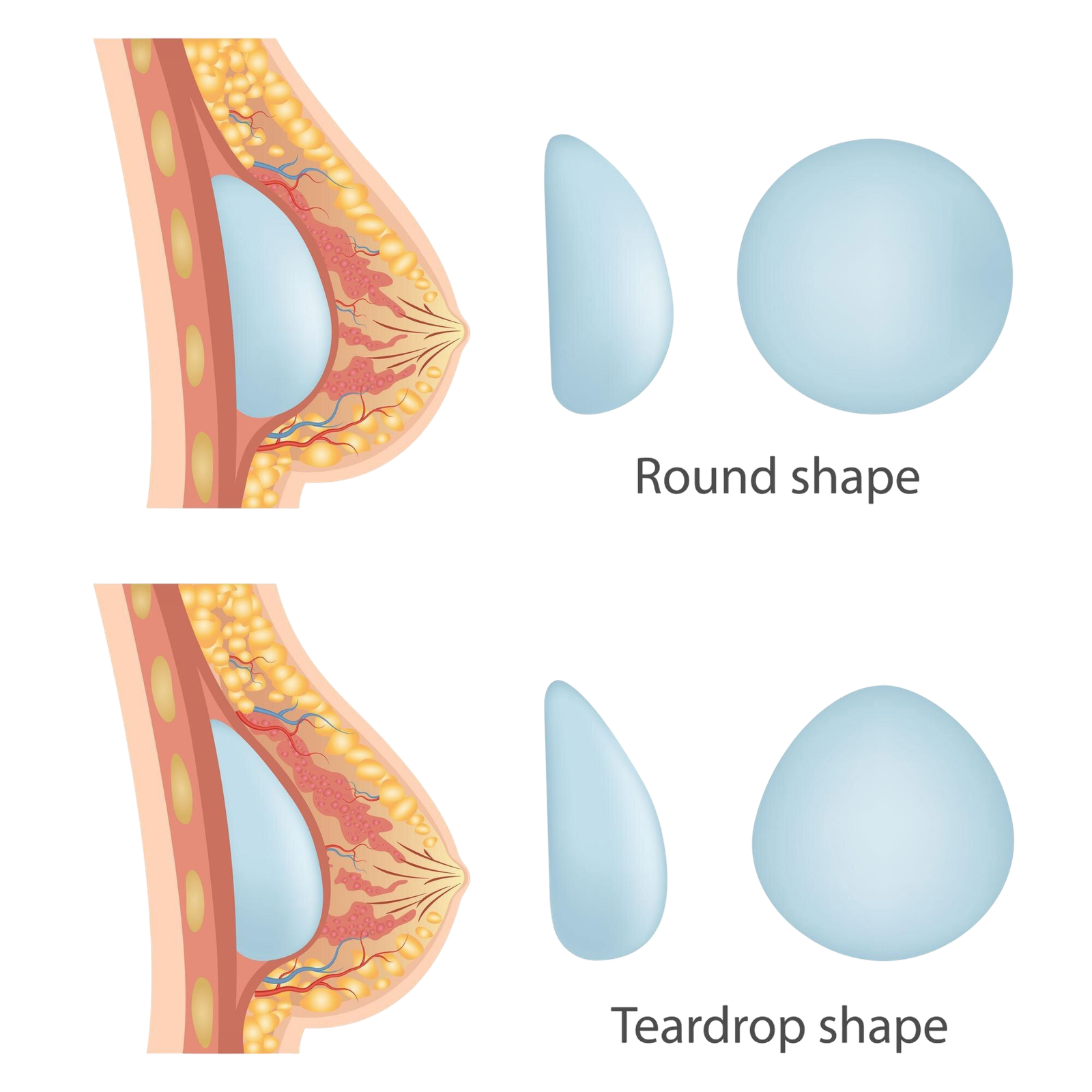 silicone vs saline breast implants