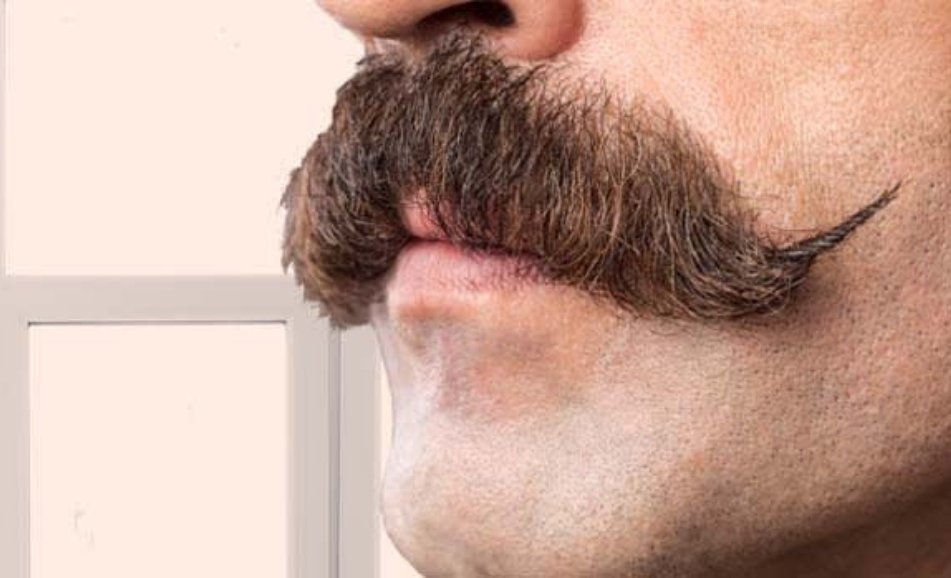 Moustache Transplant in Turkey: How Many Grafts You Need for a Full, Natural Look 1 Specialized hair restoration surgeon conducting a pre-operative facial symmetry and density evaluation in Istanbul