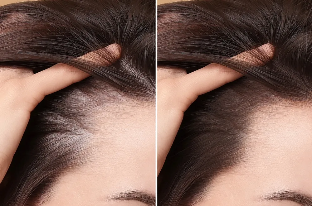 Hairline Lowering for Women in Turkey: Forehead Reduction Surgery or Hair Transplant? 1 Specialized plastic surgeon measuring upper third facial proportions and scalp laxity in an accredited Istanbul hospital