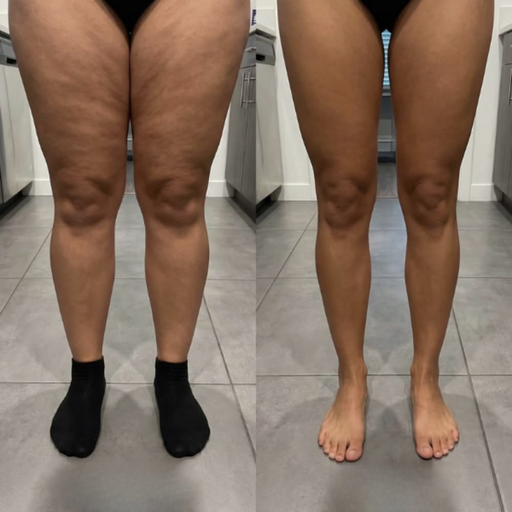 Lipedema Liposuction in Turkey: How It Differs From Cosmetic Lipo 2 Specialized lipedema surgeon examining lower limb fat distribution and lymphatic integrity in an accredited Istanbul hospital