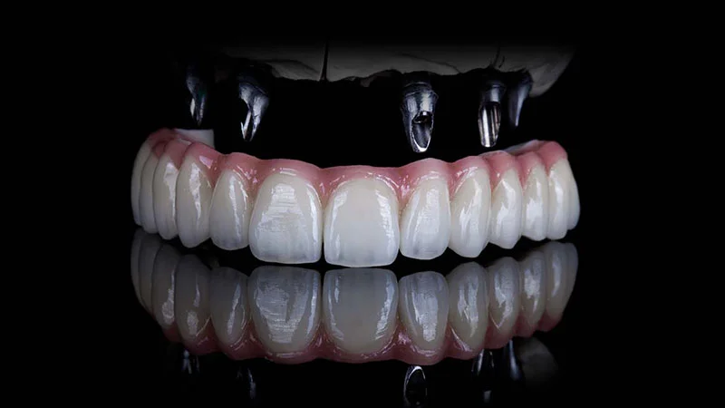 Implant-Supported Snap-On Dentures in Turkey: A Lower-Cost Alternative to All-on-4 1 Specialized prosthodontist evaluating 3D CBCT scans for implant overdenture placement in an accredited Istanbul hospital