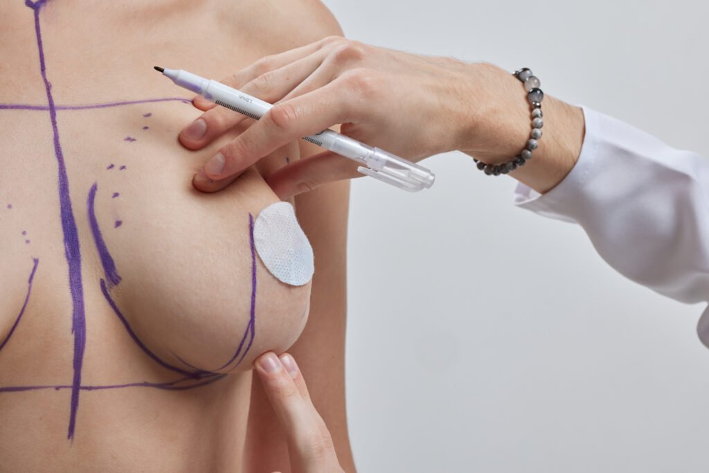 Breast Augmentation vs. Breast Lift in Turkey: Which One Do You Need After Weight Loss? 1 Detailed anatomical diagram illustrating tissue sagging correction during mastopexy and implant placement