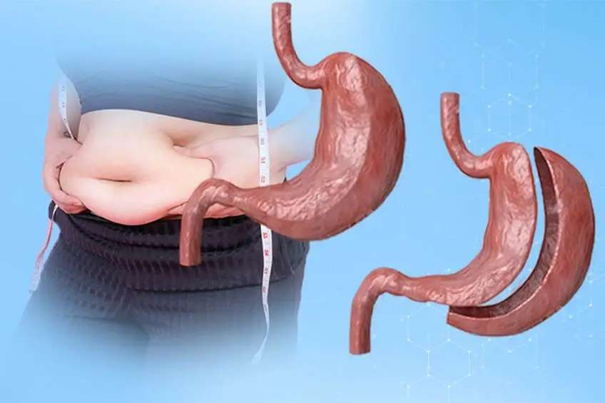 Gastric Sleeve vs. Gastric Bypass in Turkey: Which Is Better if You Have Type 2 Diabetes? 2 Specialized metabolic surgeon evaluating blood glucose levels and metabolic health parameters