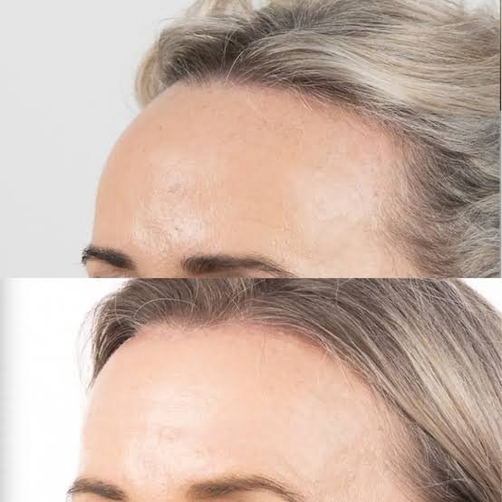 Medical comparison between surgical forehead reduction and female hair transplant for hairline lowering in Turkey