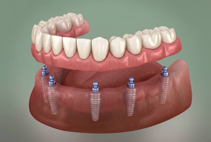 Comprehensive medical guide to implant supported snap-on dentures in turkey as a lower cost alternative to all-on-4