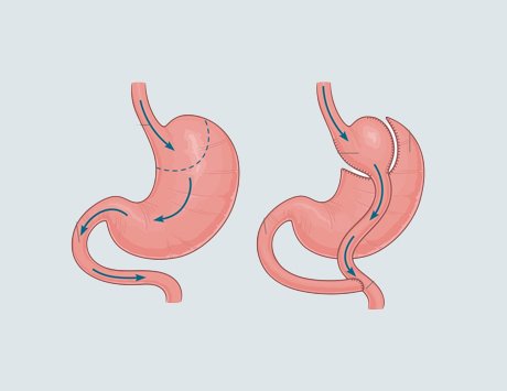 Gastric Sleeve vs. Gastric Bypass in Turkey: Which Is Better if You Have Type 2 Diabetes? 1 Advanced laparoscopic instruments used during bariatric and metabolic surgeries in accredited hospitals