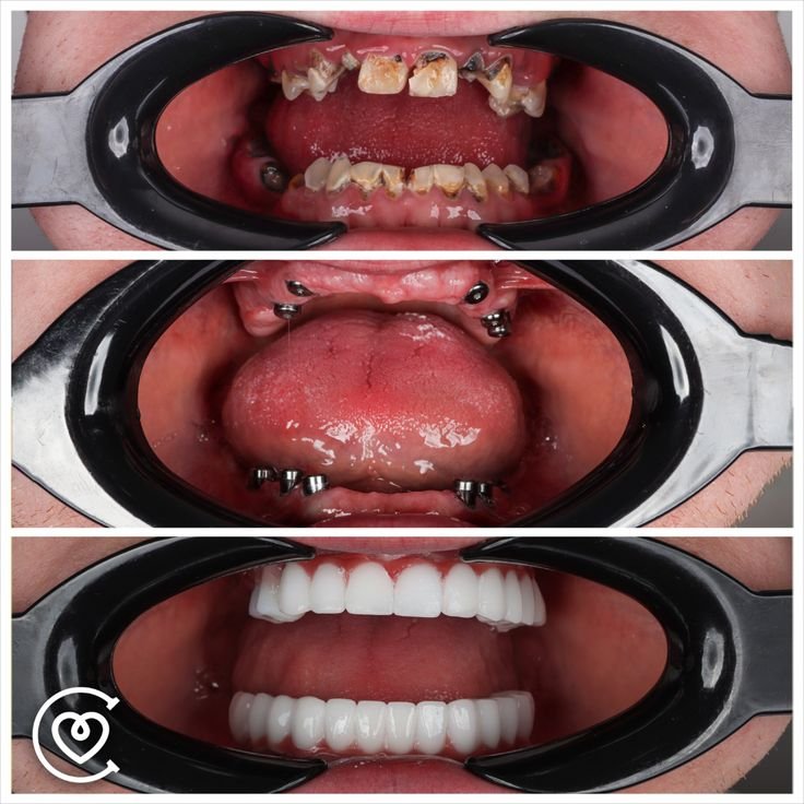 Implant-Supported Snap-On Dentures in Turkey: A Lower-Cost Alternative to All-on-4 2 Precision locator attachment system on dental implants and snap-on removable overdenture prosthesis