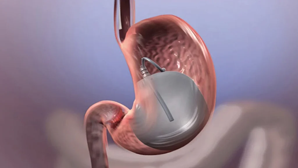 Swallowable Gastric Balloon in Turkey: No Endoscopy Procedure, Cost vs UK and Who Qualifies 2 Premium healthcare facilities and patient care rooms at an accredited bariatric clinic in Turkey