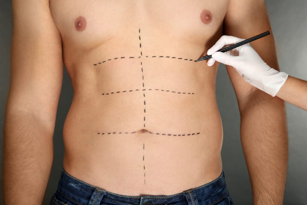 Abdominal Etching in Turkey: How Lean Do You Need to Be? A Body Fat Guide Before You Book 1 Patient showing toned and sculpted six-pack abs after surgery in Turkey