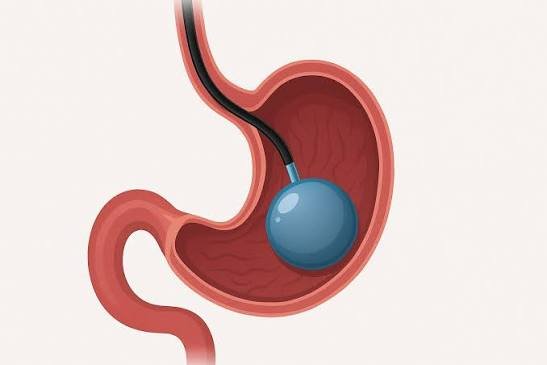 Ozempic or Gastric Balloon? Comparing Weight Loss Options in Turkey for a BMI of 27–35 2 Swallowable Allurion gastric balloon pill capsule and GLP1 semaglutide injection pen for non-surgical weight loss