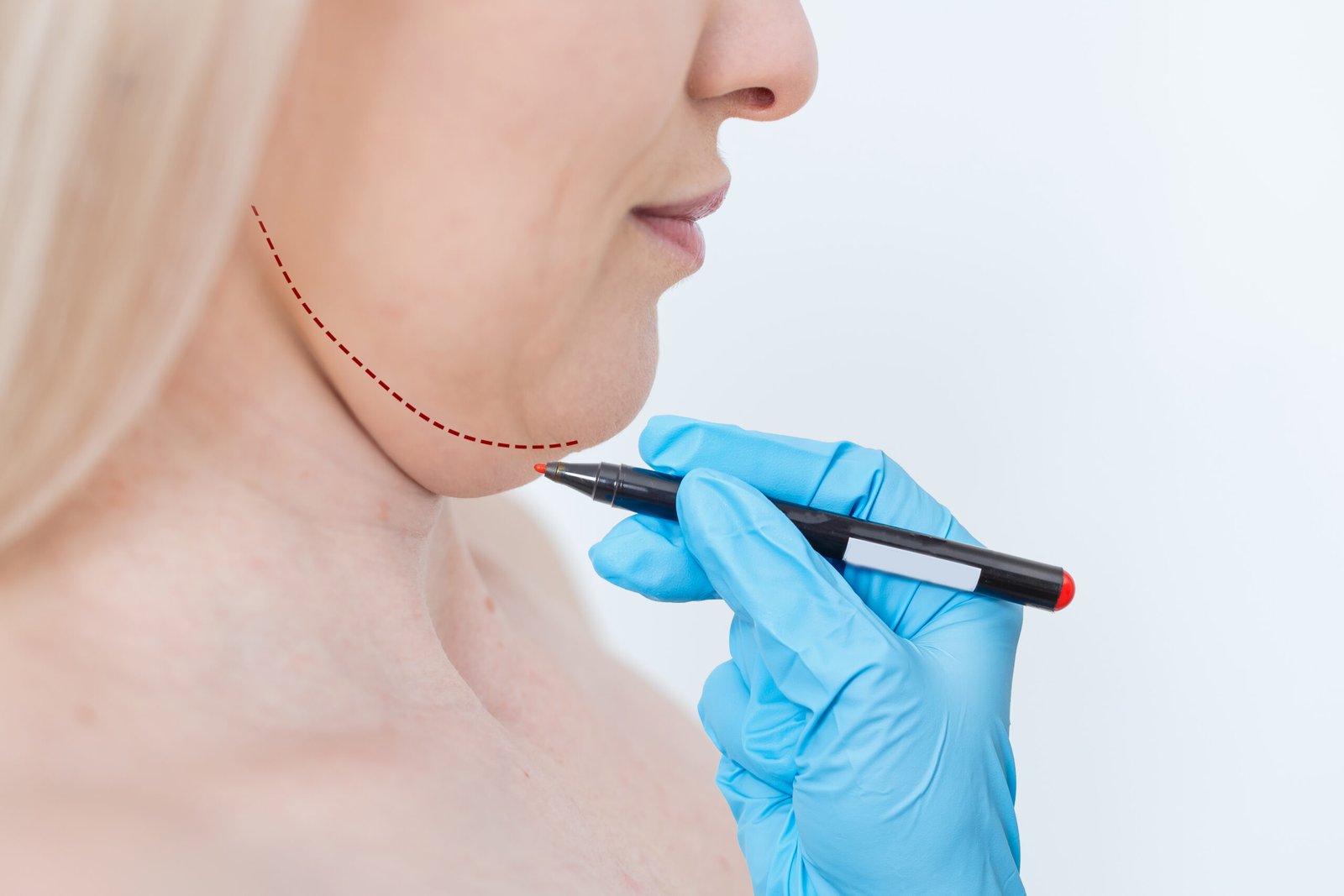 Your Premier Destination for Dental, Aesthetic, Hair Transplant & Obesity Treatments in Turkey 18 Detailed clinical comparison between thread lift procedures and surgical facelifts for jowl correction
