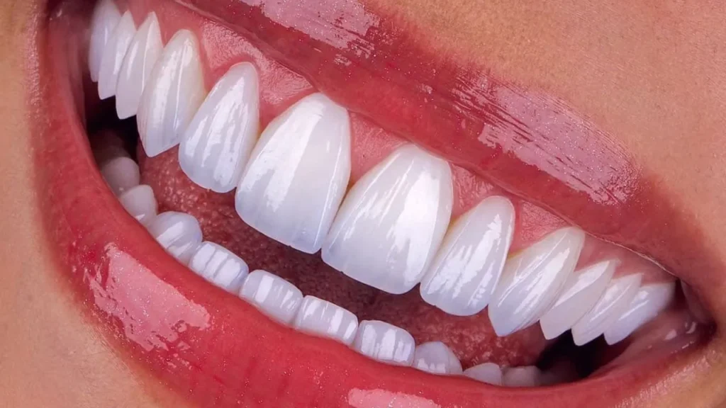 Clinical comparison diagram showing strength and translucency differences of dental materials