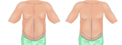 Tummy tuck before-and-after photograph showing abdominal contour improvement tummy tuck cost Turkey