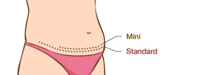 Tummy Tuck Surgery